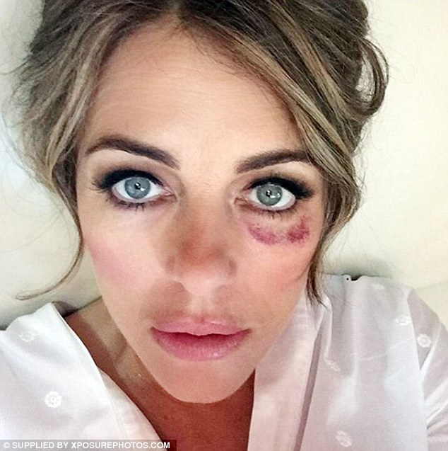 Conspiracy theorists have come up with a bizarre reason for why celebrities have sported black left eyes. Elizabeth Hurley shared a snap of herself with bruising in 2017 