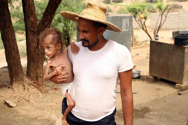 Ali Muhammad, father of malnourished Muath Ali Muhammad, holds him near their home in Aslam district of the northwestern province of Hajja, Yemen July 30, 2019. Picture taken July 30, 2019. REUTERS/Eissa Alragehi. 
